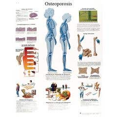 Anatomical chart: osteoporosis, paper