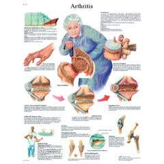 Anatomical chart: arthritis, paper