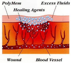 PolyMem Dressings protect the wound as they facilitate the body's natural healing process.