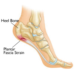 Tips For Relieving Plantar Fasciitis Pain