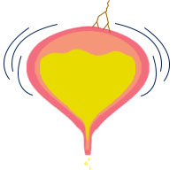 Reflex Neurogenic Incontinence Reflex Incontinence