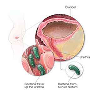 CAUTI - Catheter-Associated Urinary Tract Infections